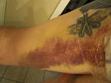 Bruising